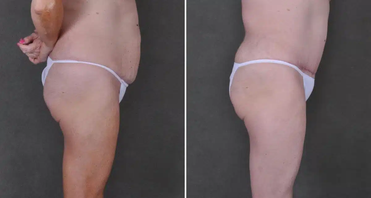 Tummy Tuck Before and After Photos in Omaha, NE, Case 9191