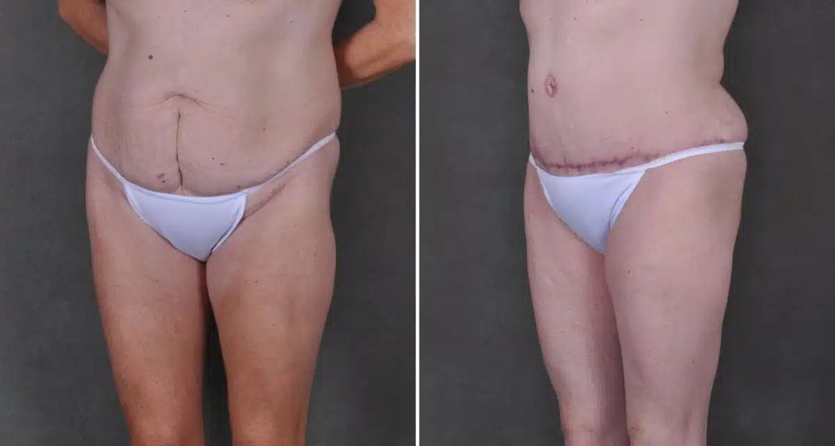 Tummy Tuck Before and After Photos in Omaha, NE, Case 9191