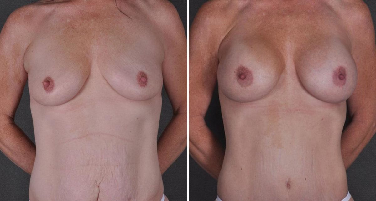 Case 9240, Tummy Tuck Before and After Photos Tummy Tuck Before and After Photos in Omaha, NE, Case 9240