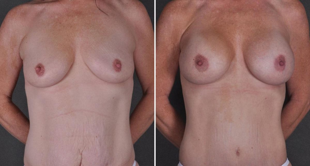 Tummy Tuck Before and After Photos in Omaha, NE, Case 9240