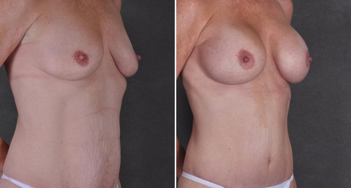 Case 9240, Tummy Tuck Before and After Photos Tummy Tuck Before and After Photos in Omaha, NE, Case 9240