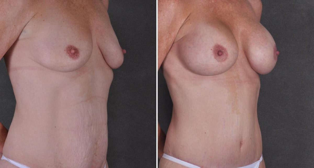 Tummy Tuck Before and After Photos in Omaha, NE, Case 9240