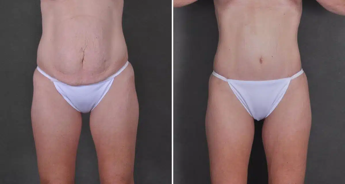 Case 9240, Tummy Tuck Before and After Photos Tummy Tuck Before and After Photos in Omaha, NE, Case 9240