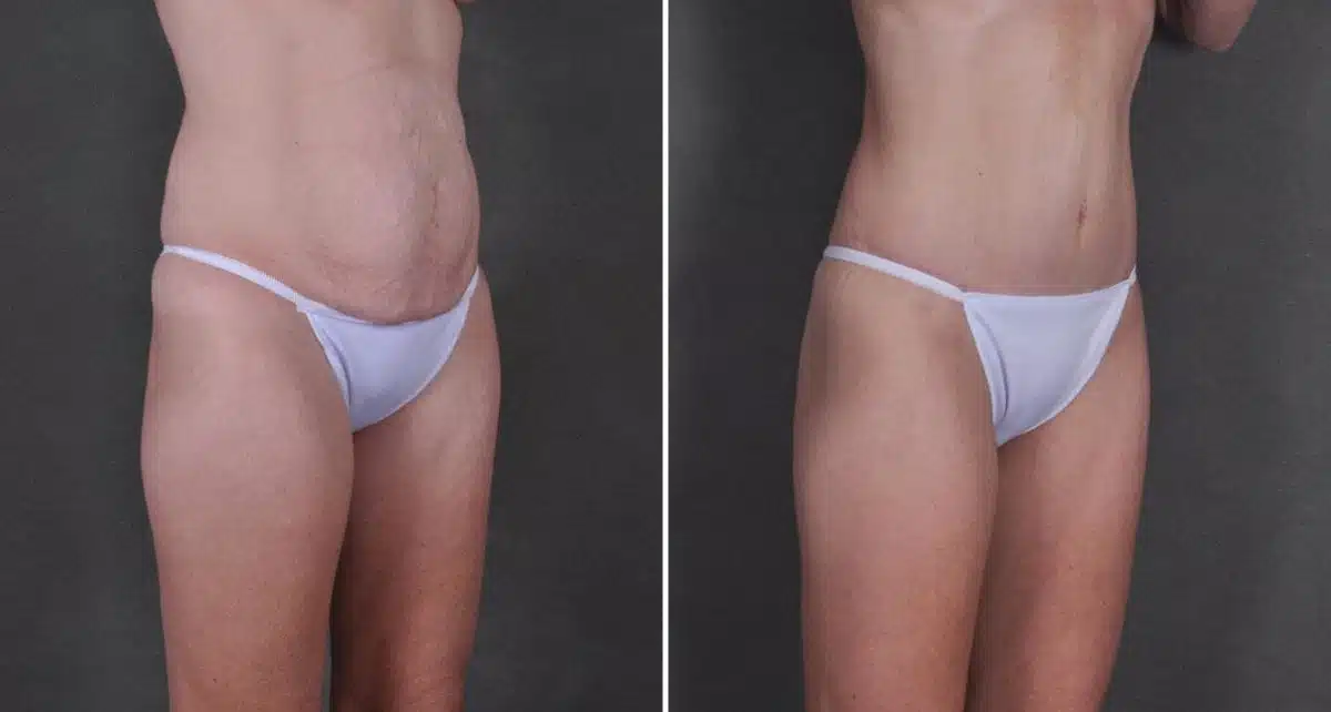 Case 9240, Tummy Tuck Before and After Photos Tummy Tuck Before and After Photos in Omaha, NE, Case 9240