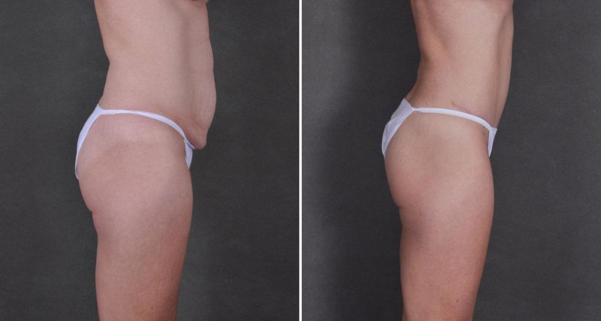 Case 9240, Tummy Tuck Before and After Photos Tummy Tuck Before and After Photos in Omaha, NE, Case 9240