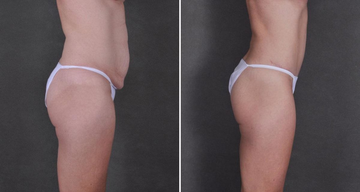 Tummy Tuck Before and After Photos in Omaha, NE, Case 9240