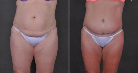 Tummy Tuck Before and After Photos in Omaha, NE, Case 9275