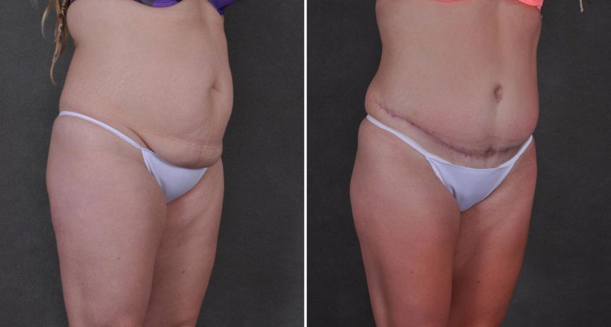 Tummy Tuck Before and After Photos in Omaha, NE, Case 9275