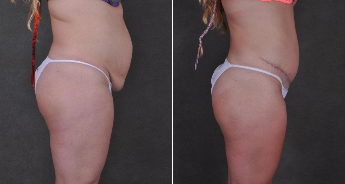 Tummy Tuck Before and After Photos in Omaha, NE, Case 9275