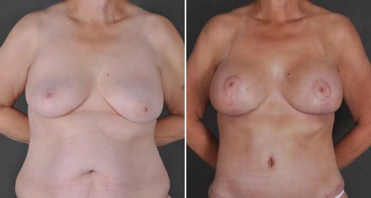 Tummy Tuck Before and After Photos in Omaha, NE, Case 9300