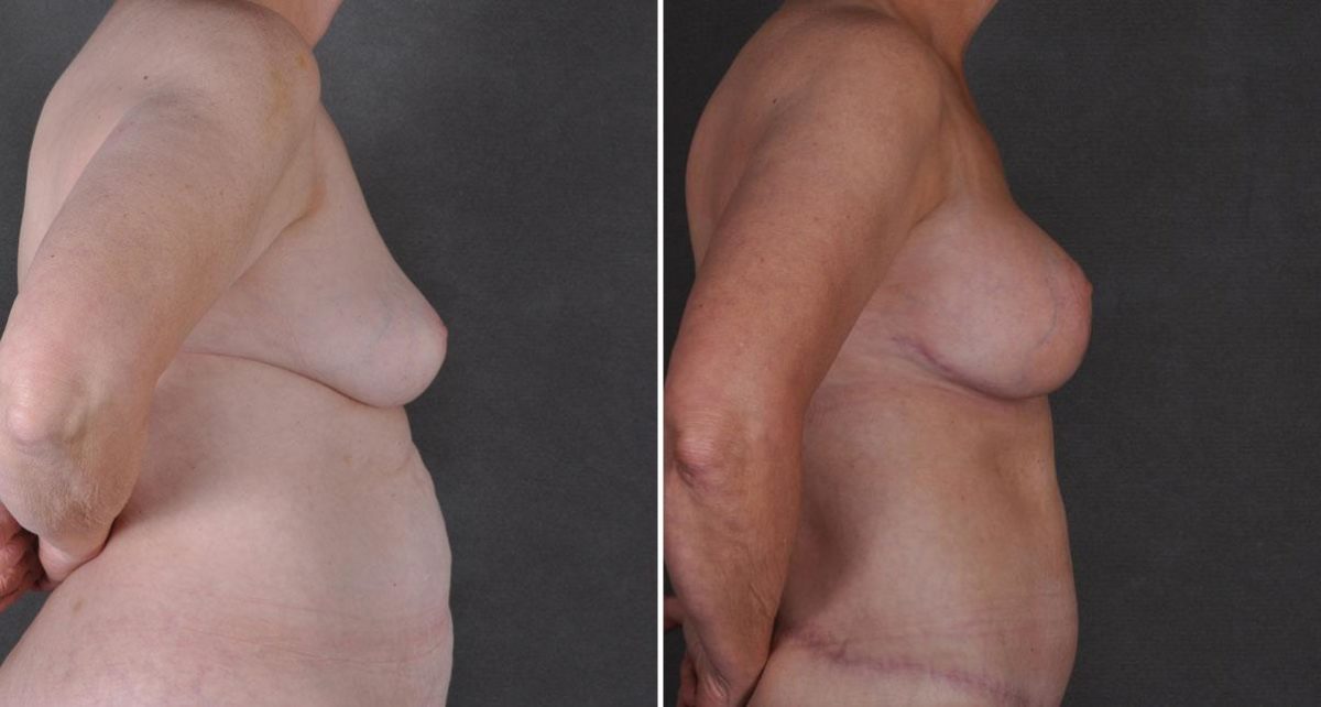 Case 9300, Tummy Tuck Before and After Photos Tummy Tuck Before and After Photos in Omaha, NE, Case 9300