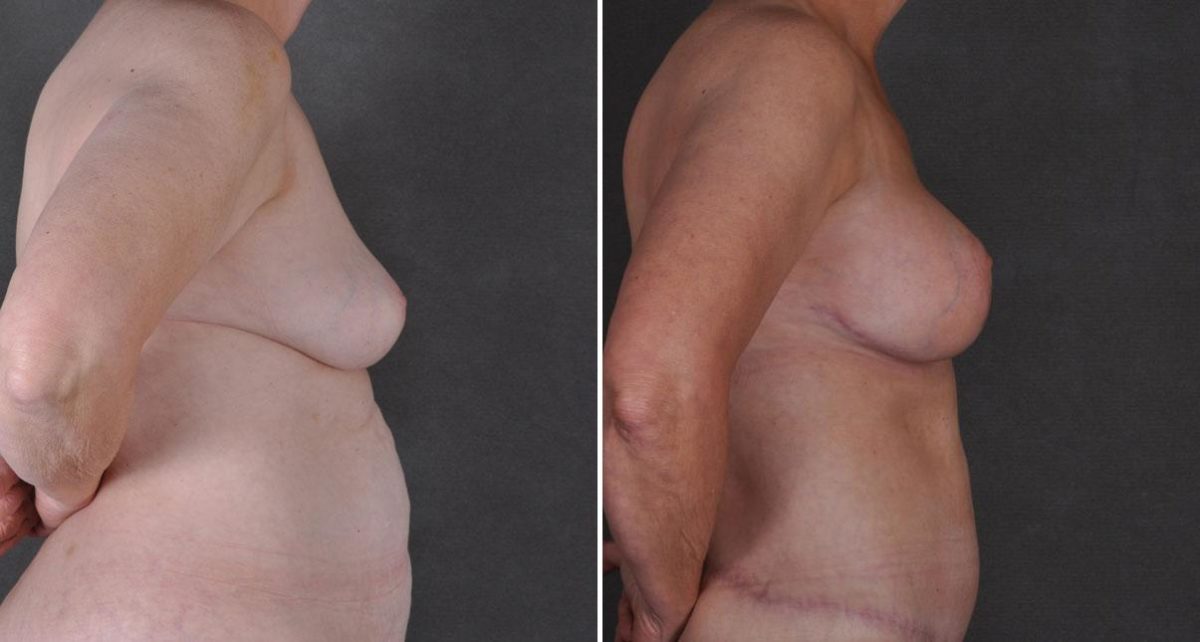 Tummy Tuck Before and After Photos in Omaha, NE, Case 9300