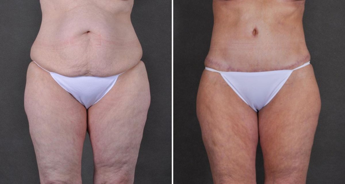 Tummy Tuck Before and After Photos in Omaha, NE, Case 9300