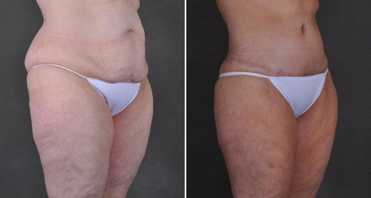 Tummy Tuck Before and After Photos in Omaha, NE, Case 9300