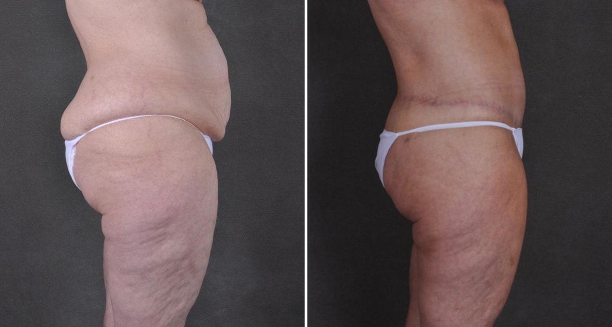 Tummy Tuck Before and After Photos in Omaha, NE, Case 9300