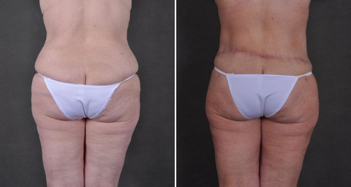 Tummy Tuck Before and After Photos in Omaha, NE, Case 9300