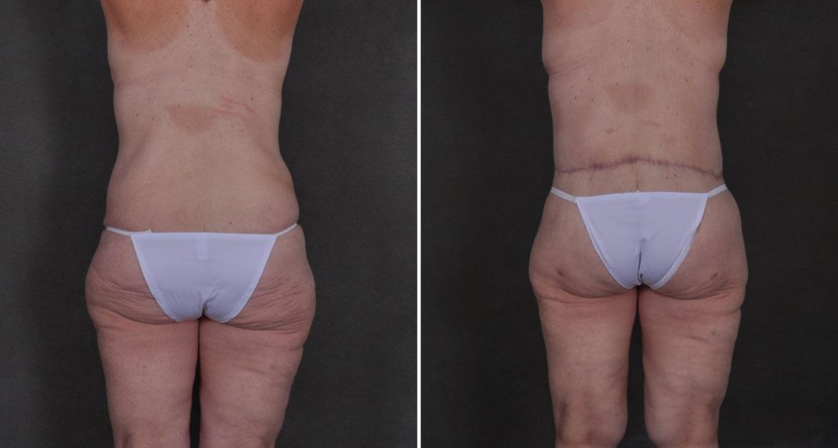 Case 8903, Tummy Tuck Before and After Photos Tummy Tuck Before and After Photos in Omaha, NE, Case 8903