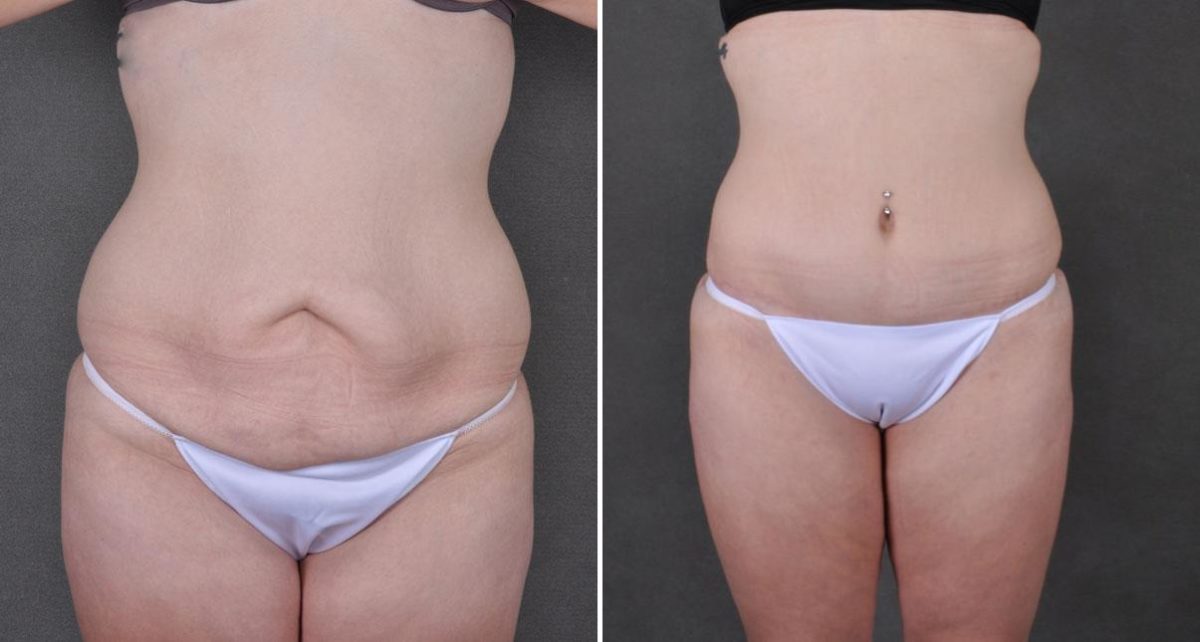 Case 8941, Tummy Tuck Before and After Photos Tummy Tuck Before and After Photos in Omaha, NE, Case 8941