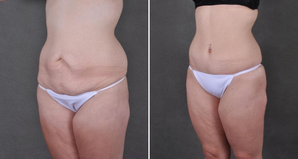 Case 8941, Tummy Tuck Before and After Photos Tummy Tuck Before and After Photos in Omaha, NE, Case 8941