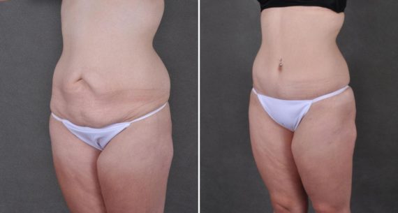 Tummy Tuck Before and After Photos in Omaha, NE, Case 8941