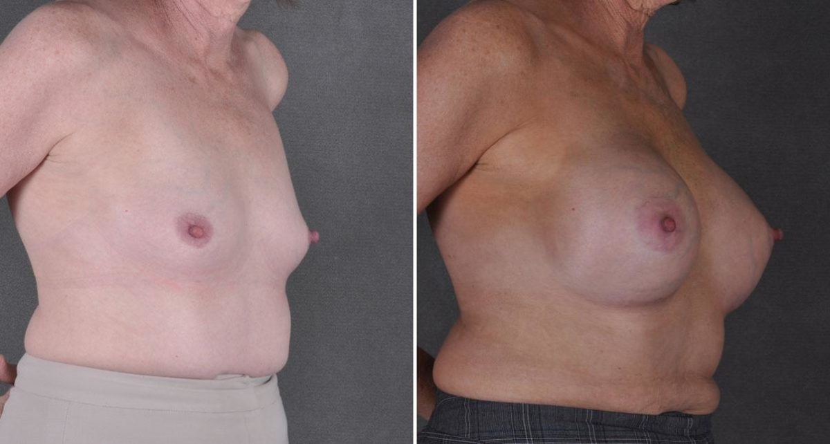 Breast Augmentation Before and After Photos in Omaha, NE, Case 8958