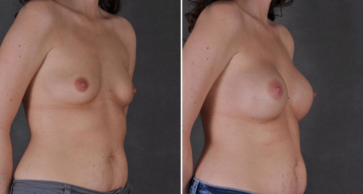 Breast Augmentation Before and After Photos in Omaha, NE, Case 8996