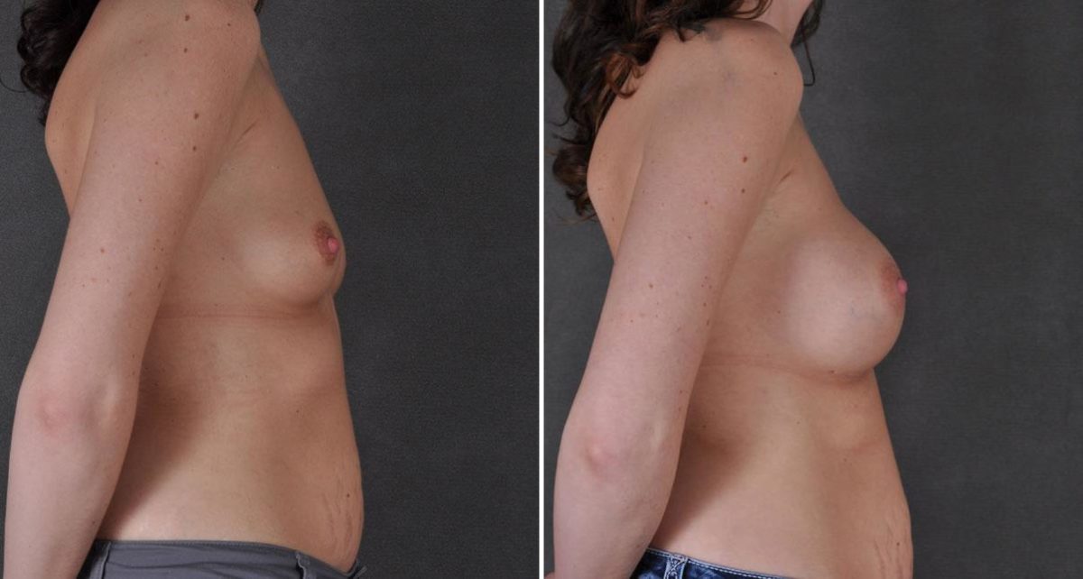 Breast Augmentation Before and After Photos in Omaha, NE, Case 8996