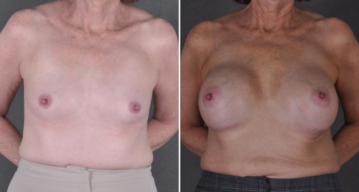 Breast Augmentation Before and After Photos in Omaha, NE, Case 8958