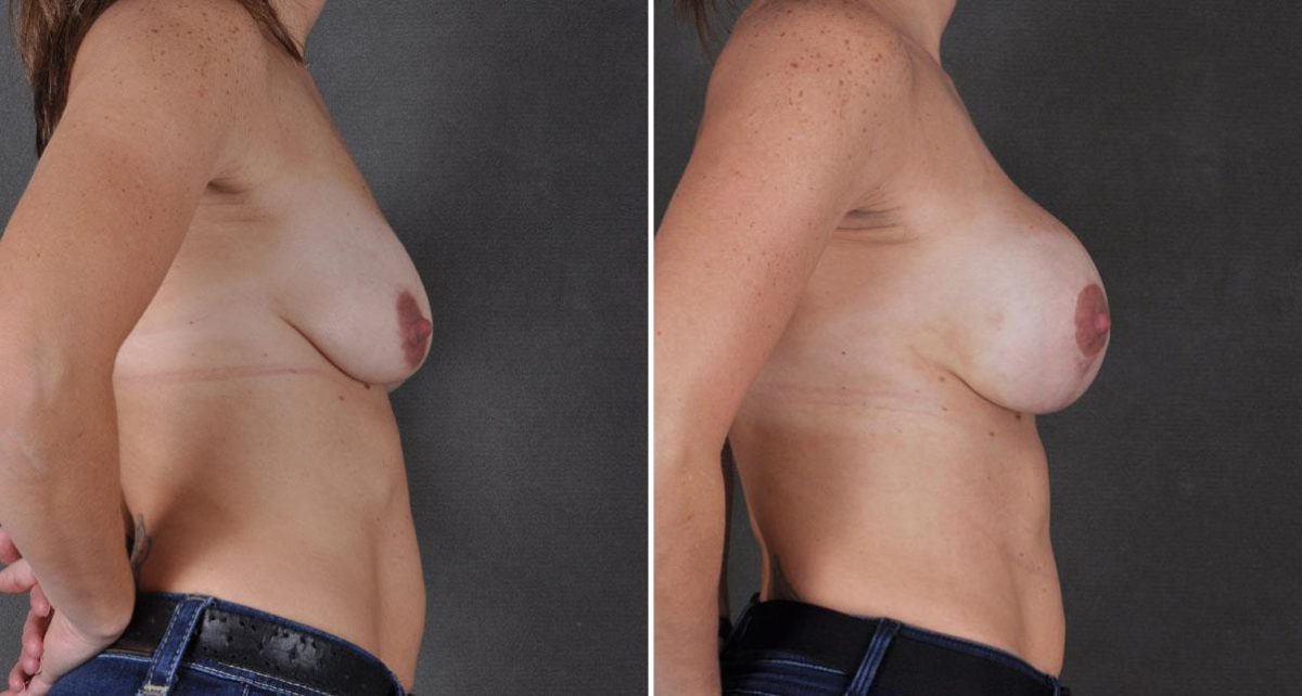 Breast Augmentation Before and After Photos in Omaha, NE, Case 9003