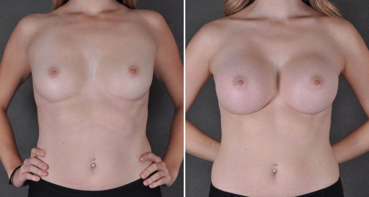 Breast Augmentation Before and After Photos in Omaha, NE, Case 9010