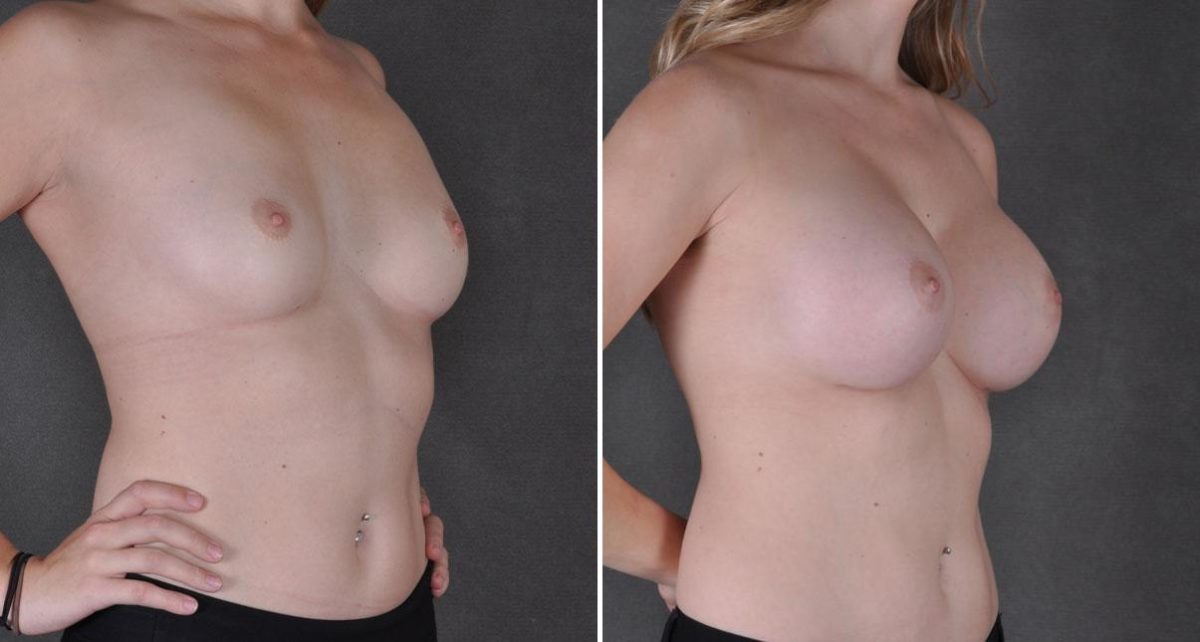 Breast Augmentation Before and After Photos in Omaha, NE, Case 9010