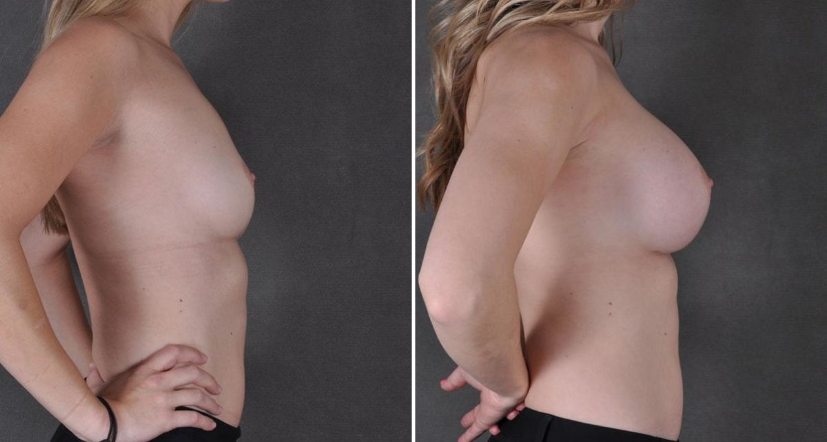 Breast Augmentation Before and After Photos in Omaha, NE, Case 9010