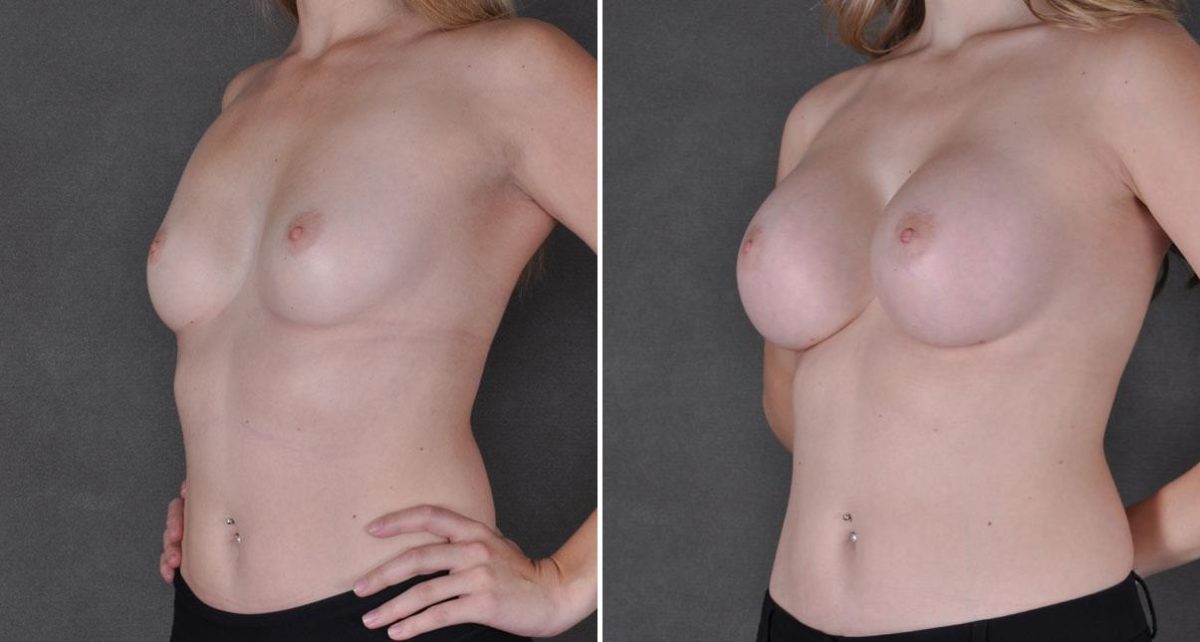 Breast Augmentation Before and After Photos in Omaha, NE, Case 9010