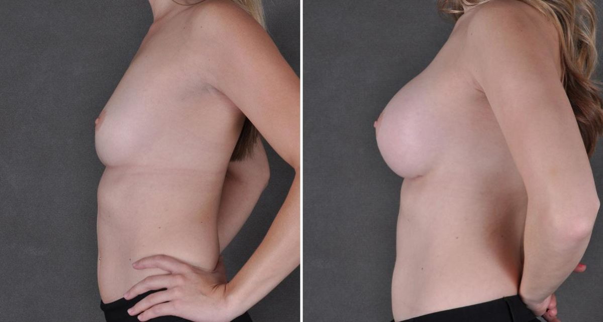 Breast Augmentation Before and After Photos in Omaha, NE, Case 9010