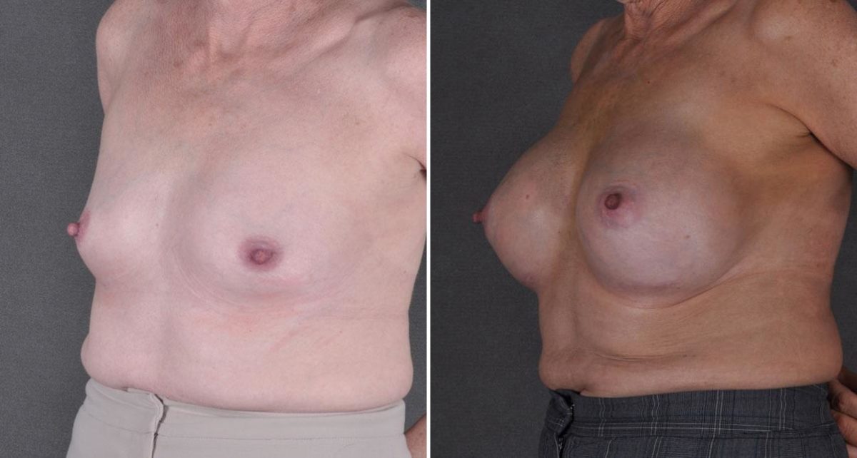 Breast Augmentation Before and After Photos in Omaha, NE, Case 8958