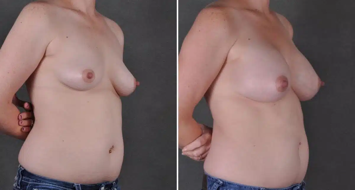 Breast Augmentation Before and After Photos in Omaha, NE, Case 9027