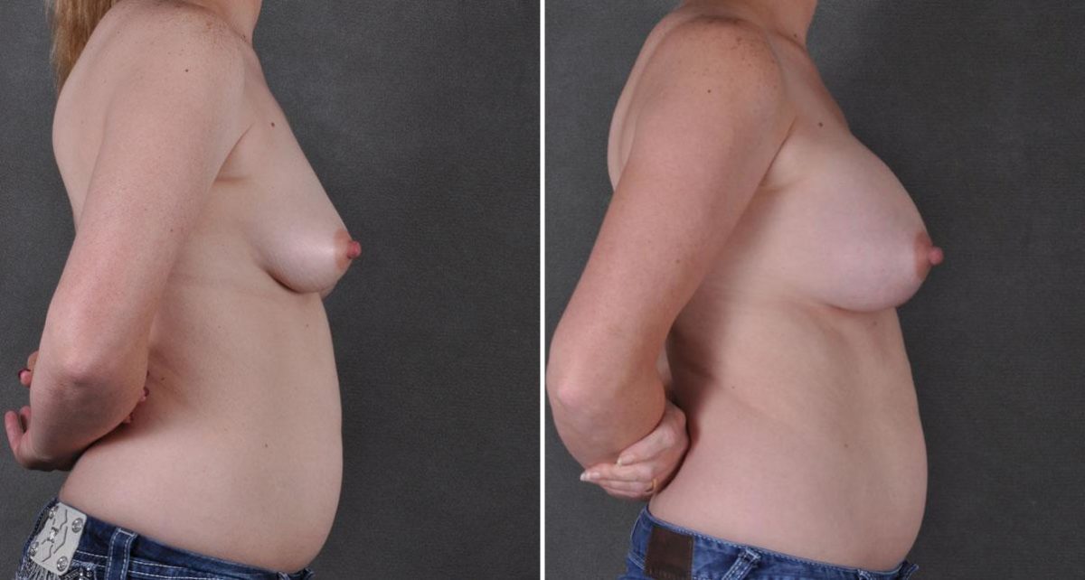 Breast Augmentation Before and After Photos in Omaha, NE, Case 9027