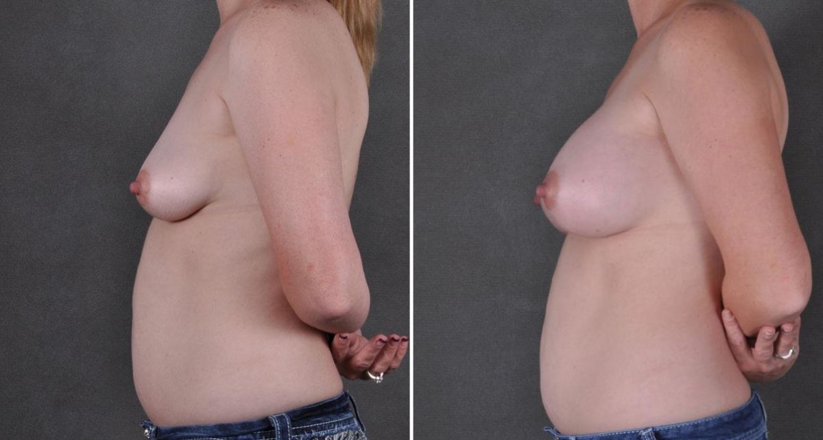 Breast Augmentation Before and After Photos in Omaha, NE, Case 9027