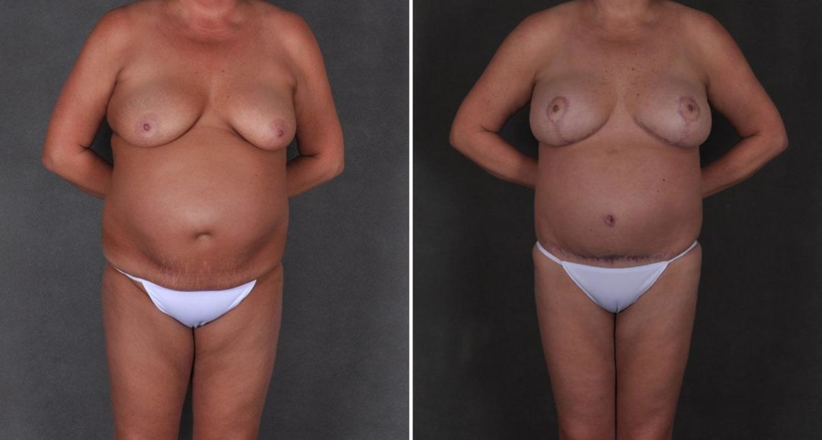 Breast Augmentation Before and After Photos in Omaha, NE, Case 9203