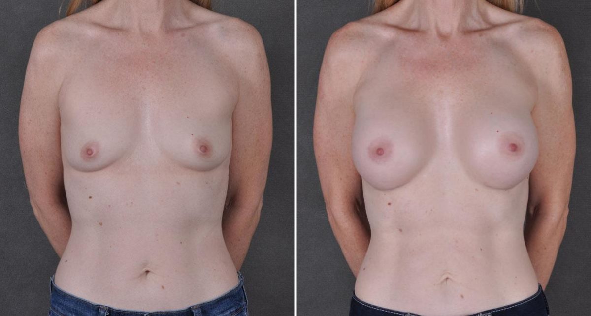 Breast Augmentation Before and After Photos in Omaha, NE, Case 9038