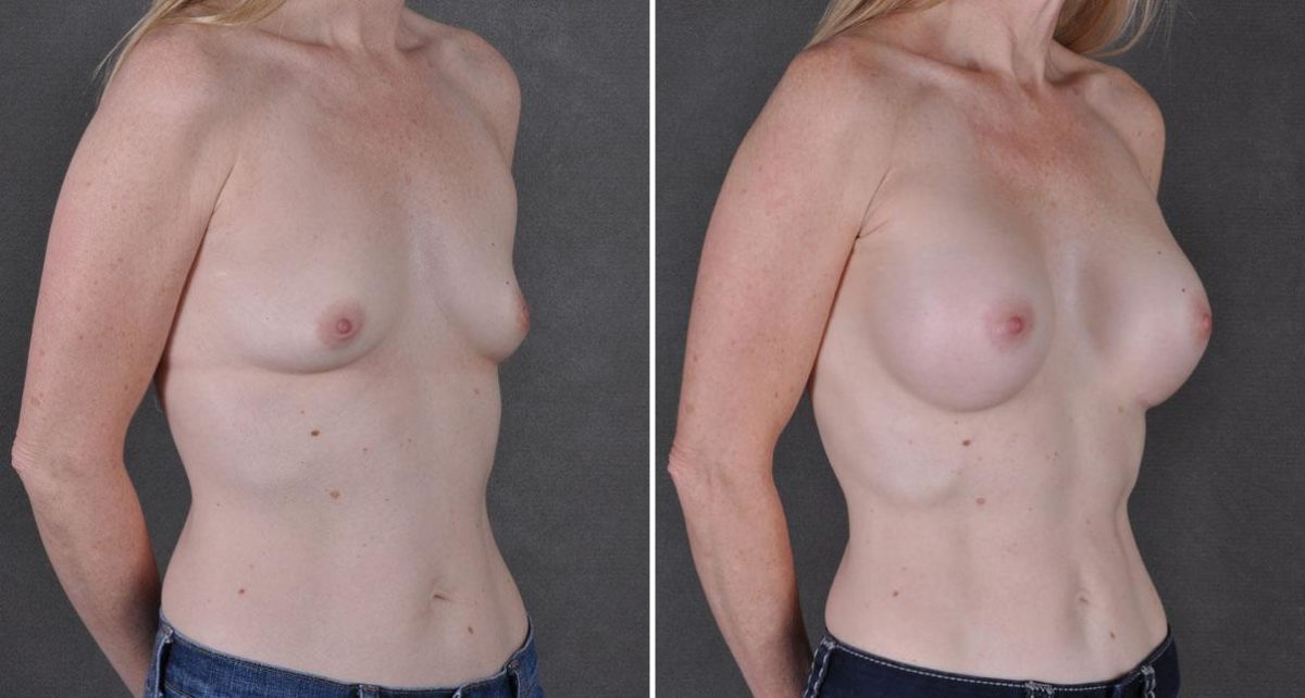 Breast Augmentation Before and After Photos in Omaha, NE, Case 9038