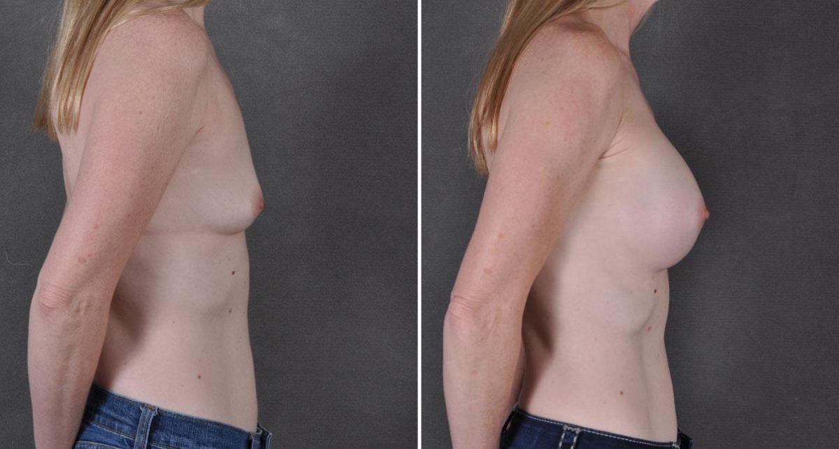 Breast Augmentation Before and After Photos in Omaha, NE, Case 9038