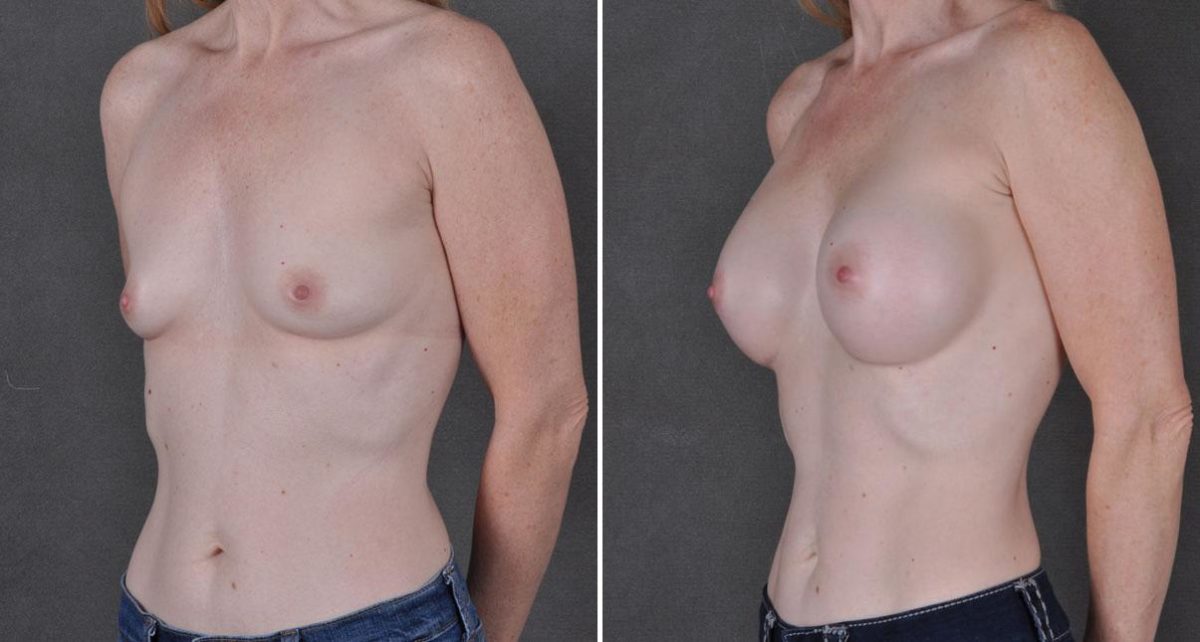 Breast Augmentation Before and After Photos in Omaha, NE, Case 9038