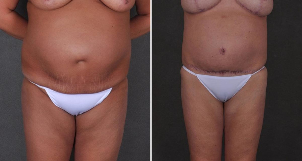 Breast Augmentation Before and After Photos in Omaha, NE, Case 9203