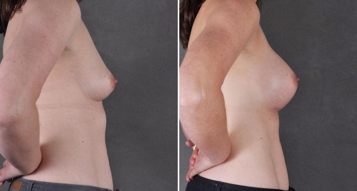 Breast Augmentation Before and After Photos in Omaha, NE, Case 9073