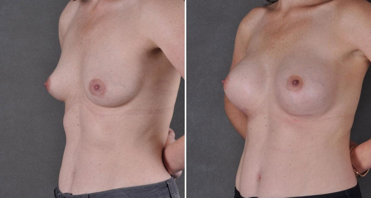 Breast Augmentation Before and After Photos in Omaha, NE, Case 9073