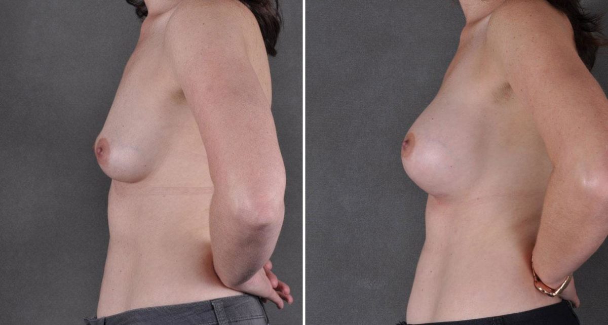 Breast Augmentation Before and After Photos in Omaha, NE, Case 9073