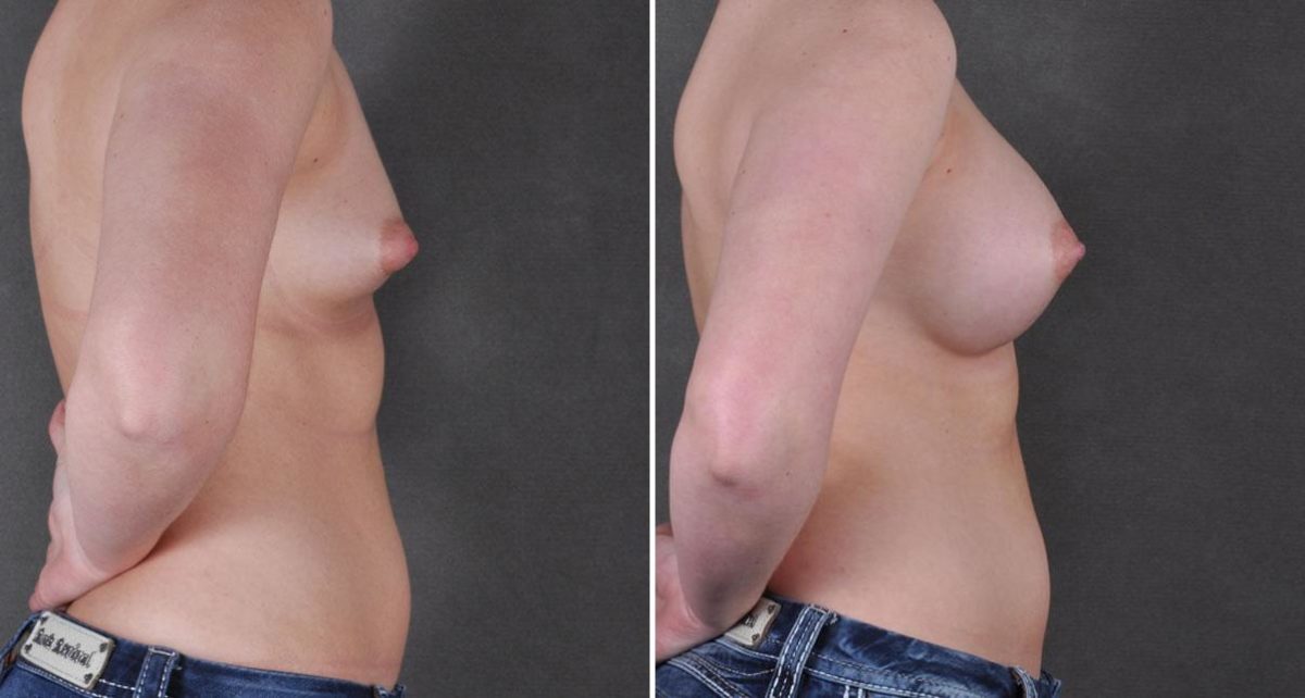 Breast Augmentation Before and After Photos in Omaha, NE, Case 9084