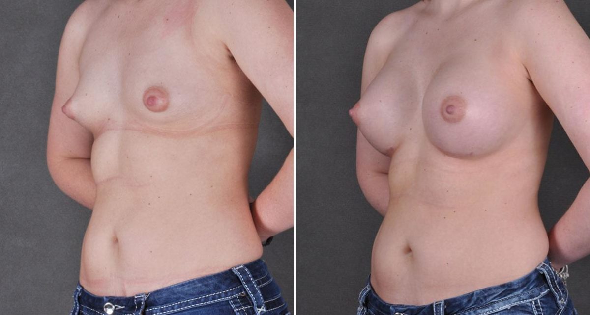 Breast Augmentation Before and After Photos in Omaha, NE, Case 9084