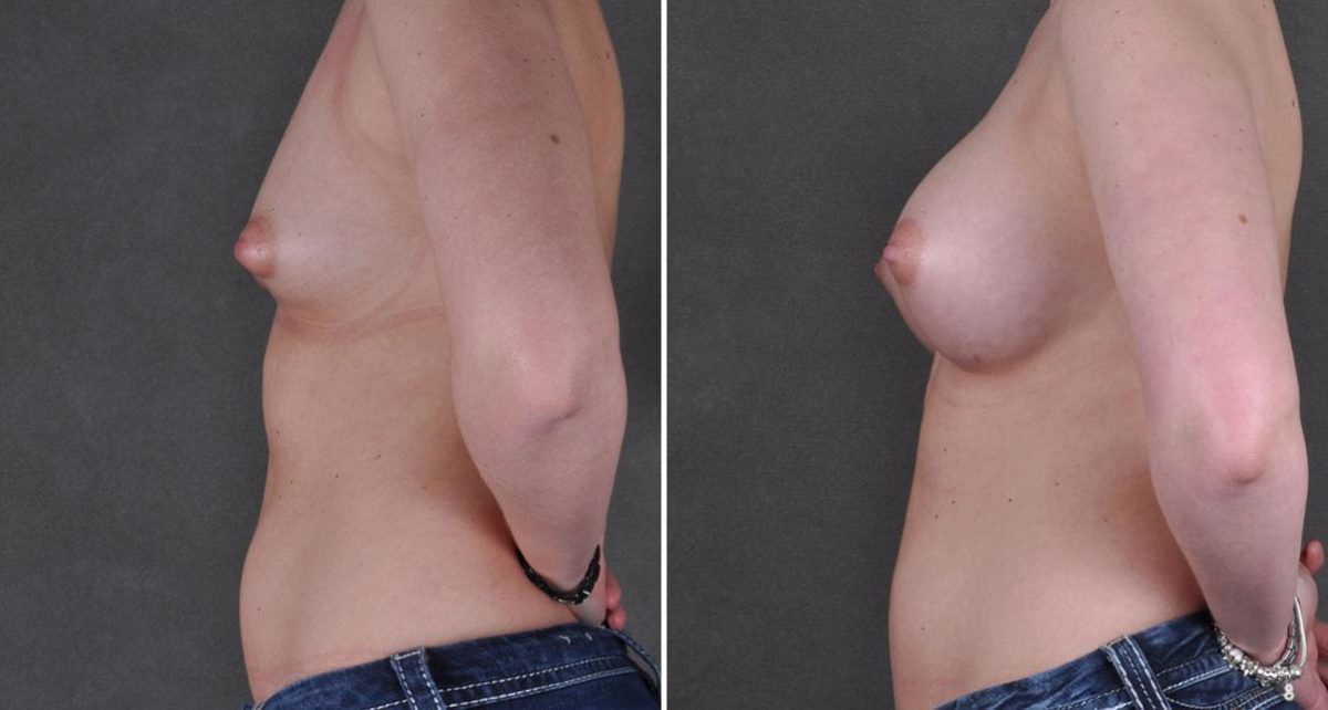 Breast Augmentation Before and After Photos in Omaha, NE, Case 9084